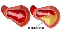Co je cholesterol a proč s ním v životě počítat? - 225260 - Cholesterol a co to je