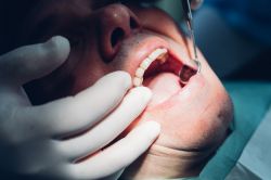 Co nejvíce škodí zubům, aneb proč vzniká zubní kaz - 227624 - Co nejvíce škodí zubům?